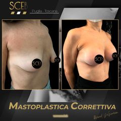 Mastoplastica additiva - SCEB - Dott. Manuel De Giovanni