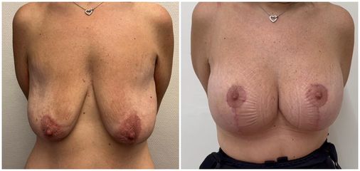 Mastopessi - SCEB - Dott. Manuel De Giovanni - Medicina e Chirurgia Estetica