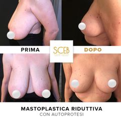 Dott. Manuel De Giovanni Mastoplastica riduttiva