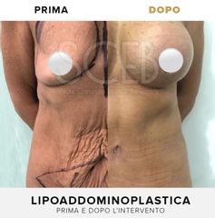 Dott. Manuel De Giovanni Lipo addominoplastica