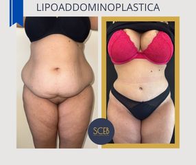 Dott. Manuel De Giovanni Lipoaddominoplastica Prima e Dopo