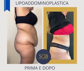 Dott. Manuel De Giovanni lipoaddominoplastica