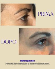 Dott. Manuel De Giovanni Blefaroplastica superiore