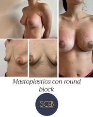 Dott. Manuel De Giovanni Mastoplastica con round block