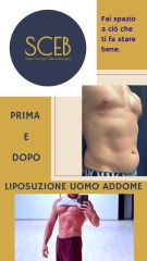 Dott. Manuel De Giovanni Liposuzione uomo addome