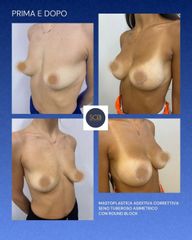 MASTOPLASTICA ADDITIVA CORRETTIVA SENO TUBEROSO ASIMETRICO CON ROUND BLOCK - Dott. Manuel De Giovan