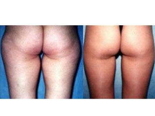 Laserlipolisi prima e dopo