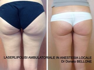 Laserlipolisi prima e dopo