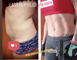 Laserlipolisi prima e dopo