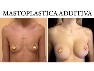 Mastoplastica additiva - Dott. Bellone Donato