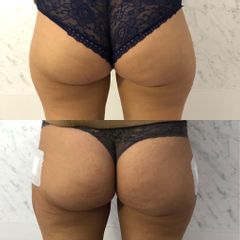 Liposuzione trocanteri prima dopo