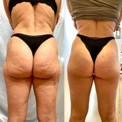 liposuzione prima dopo