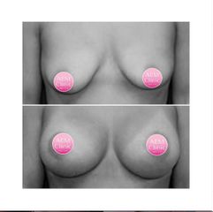 Mastopessi round block - Dr. Luca Zattoni