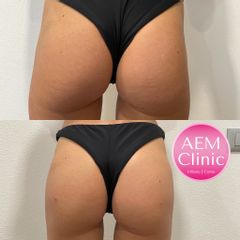 Filler Glutei - Dr. Luca Zattoni