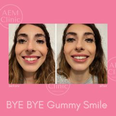 Gummy smile sorriso gengivale correzione con filler - Dr. Luca Zattoni