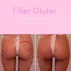 Filler Glutei Hyacorp MLF2 prima dopo
