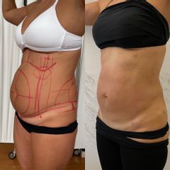 Liposuzione - Dr Luca Zattoni