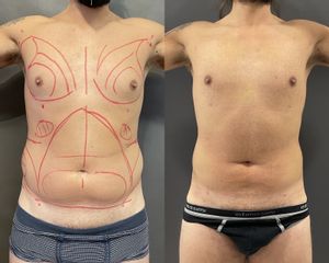 Liposuzione 360 addome, fianchi e schiena - dr Luca Zattoni