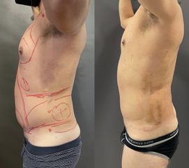 Liposuzione 360 addome, fianchi e schiena - dr Luca Zattoni