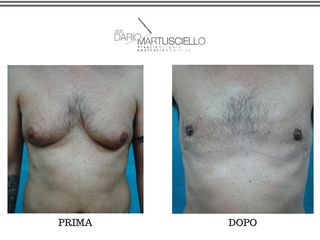 Ginecomastia prima e dopo