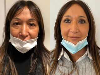 Lifting viso - Dott. Alberto Poli Cliniche Nova Genesis