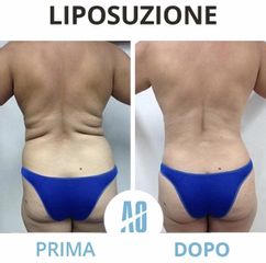 Liposuzione - Dott. Orlandi Alberto