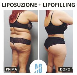 Liposuzione - Dott. Orlandi Alberto