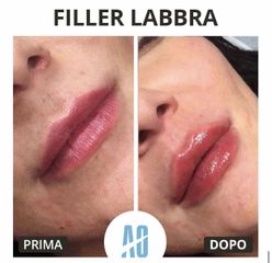 Filler labbra - Dott. Orlandi Alberto