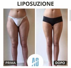Liposuzione - Dott. Orlandi Alberto