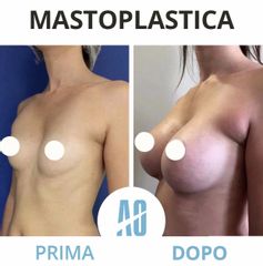 Mastoplastica additiva - Dott. Orlandi Alberto