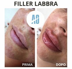 Filler labbra - Dott. Orlandi Alberto