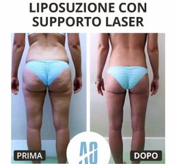 Liposuzione - Dott. Orlandi Alberto
