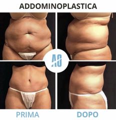 Addominoplastica - Dott. Orlandi Alberto