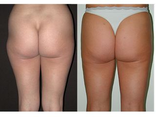 Liposcultura prima e dopo