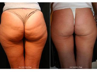Cellulite prima e dopo
