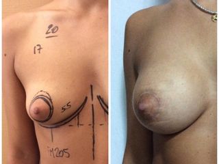 Mastoplastica tuberosa prima e dopo