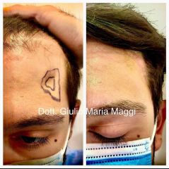Filler - Aesthetic Clinic del Dott. Giulio Maria Maggi