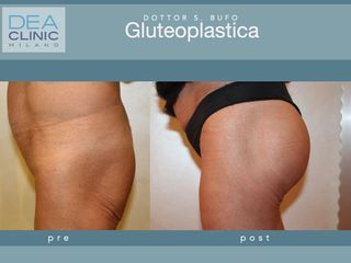 Gluteoplastica - Dott. Savino Bufo