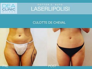 Laserlipolisi - Dott. Savino Bufo