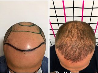 Autotrapianto capelli prima e dopo