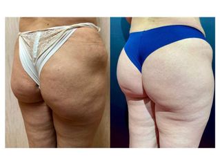 Gluteoplastica - Dott. Arturo Amoroso