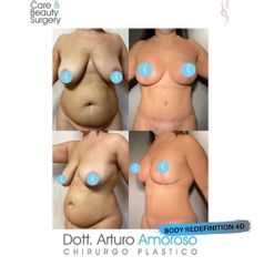 Addominoplastica - Dott. Arturo Amoroso