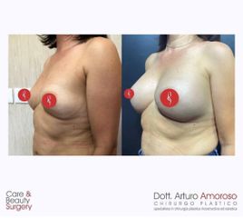 Mastoplastica additiva - Dott. Arturo Amoroso