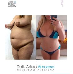 Addominoplastica - Dott. Arturo Amoroso
