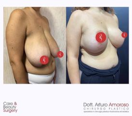 Mastoplastica riduttiva - Dott. Arturo Amoroso