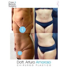 Addominoplastica - Dott. Arturo Amoroso
