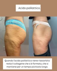 Acido polilattico Dr Amoroso