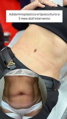 Dott. Arturo Amoroso Addominoplastica e Liposcultura
