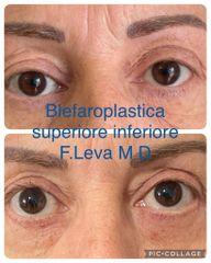 Blefaroplastica - Prof. Francesco Leva
