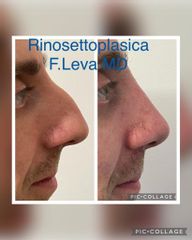 Rinoplastica - Prof. Francesco Leva